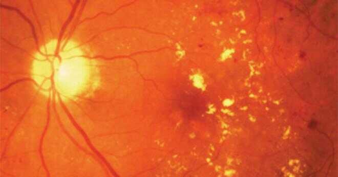 Vad är prognosen för retinopati?