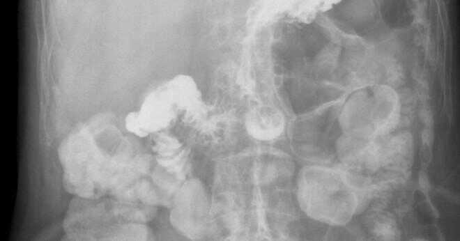 Vad är klass jag reflux esofagit av gastroesofageal korsningen?