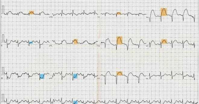 Skilja myocardial ischemia från hjärtinfarkt?