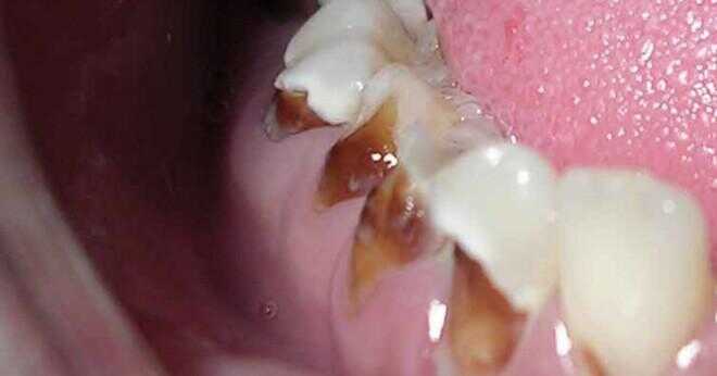 En klass II dental bettavvikelser i den blandade tandbildning vilja sannolik?