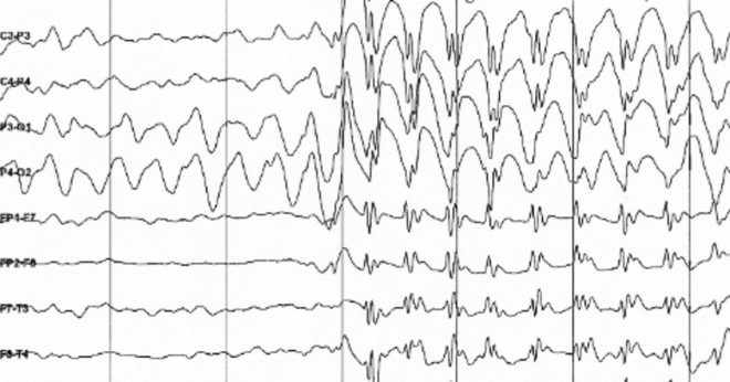 En stroke kan hända under ett epileptiskt anfall?