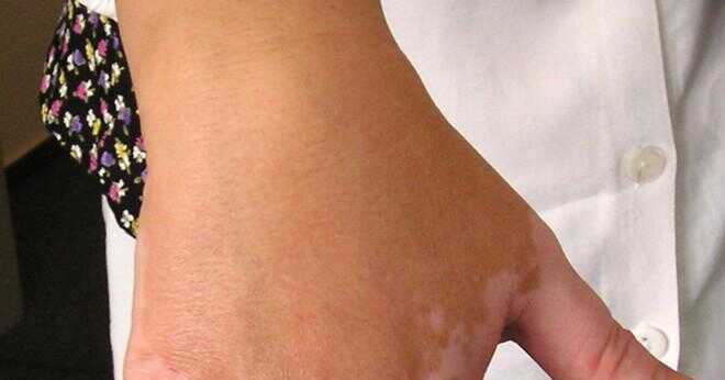 Var är de människor som har torkats av vitiligo?