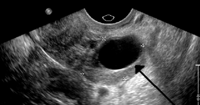 Vilka är symtomen av polycystiskt ovariesyndrom och cystor på äggstockarna?