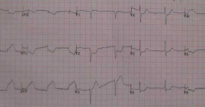 Vad vågor finns på ett EKG?