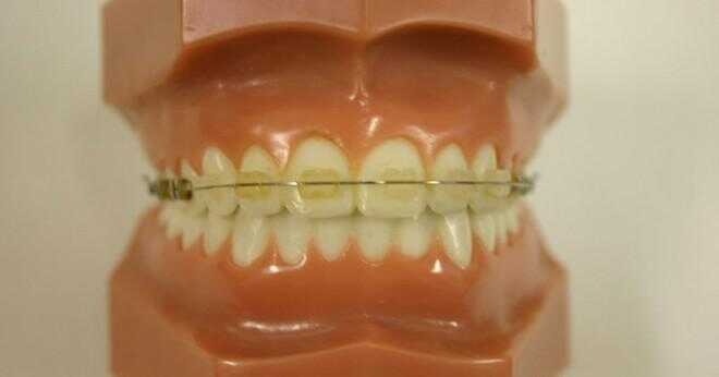 Hur länge kan en person ha tandställning för?