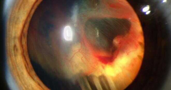 Finns det retinala komplikationer efter kataraktoperation?