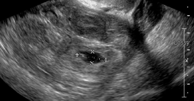 Vad är den vanligaste och mest önskvärda fosterställning i utero?