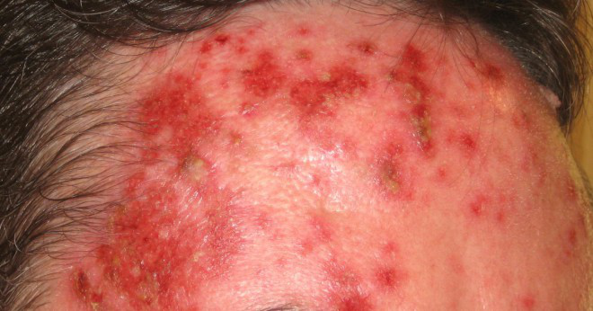 Är aktinisk keratos en precancerösa hud tillväxt som sker på solskadad hud?