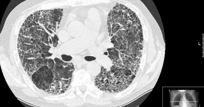 Hur diagnostiseras lungfibros?