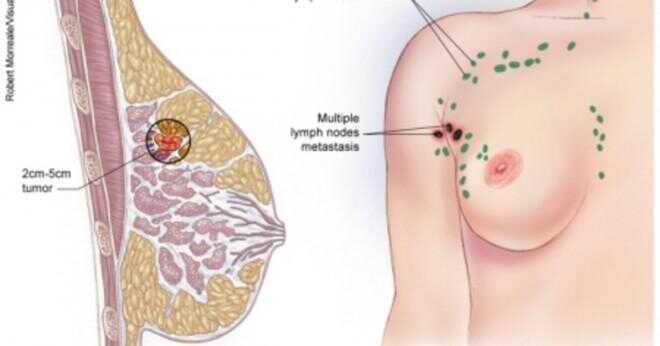 Vad kan ett mammogram upptäcka?