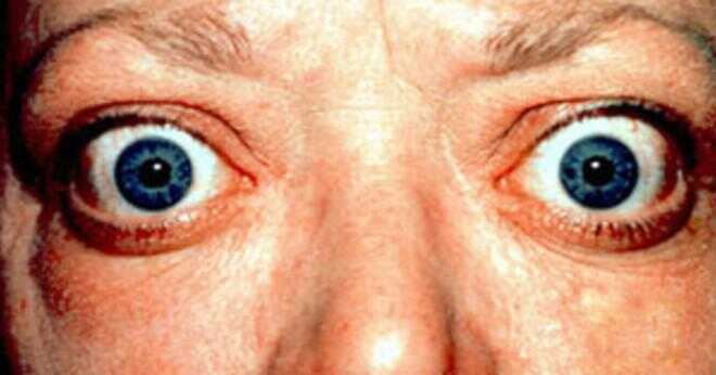 Ögonlocket plastikkirurgi kan och ta bort dåliga fettvävnad från chalazion?