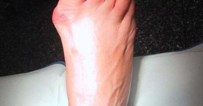 Platta fötter kan göra någon skada till dig?