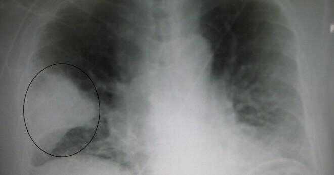 Är bronkit och lunginflammation en lång sikt eller de kortsiktiga effekter för rökare?