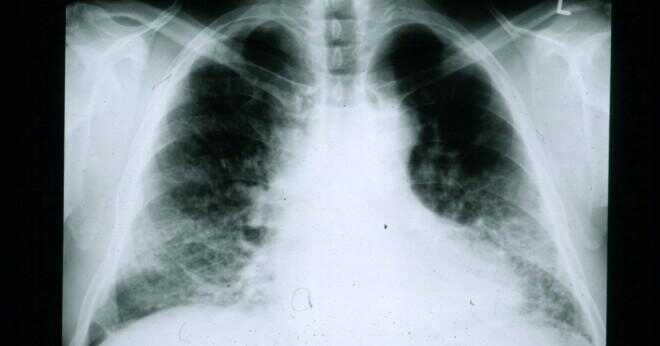 RA kan orsaka pulmonell fibros?